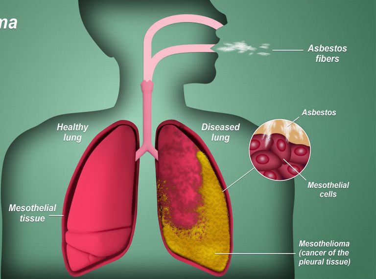 what causes mesothelioma