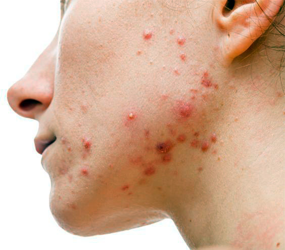 Natural Treatments for Acne