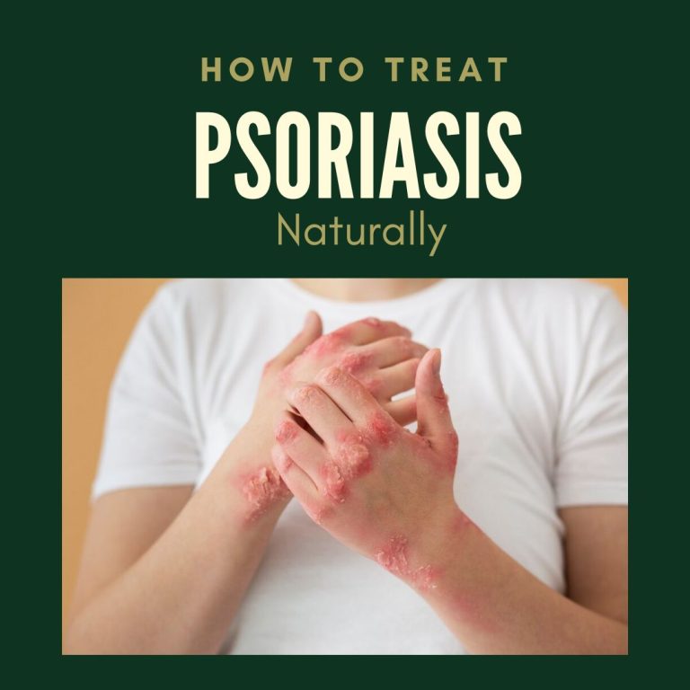 How to Treat Psoriasis Naturally