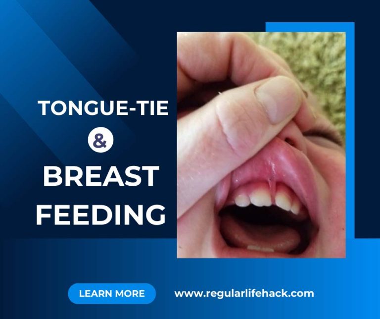 Tongue-Tie And Breastfeeding