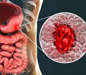 How to Heal Leaky Gut Syndrome Naturally